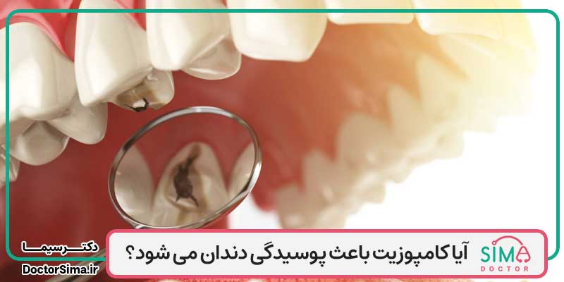 آيا كامپوزيت باعث پوسيدگی دندان می شود؟