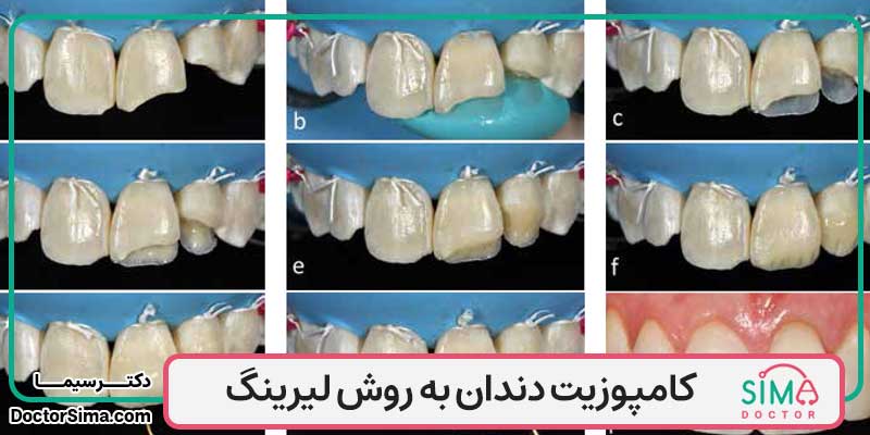 کامپوزیت دندان به روش لیرینگ (اموزش تکنیک لیرینگ کامپوزیت)